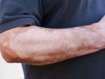 甲醛超標和白癜風有關系嗎?裝修污染對人體影響極大!